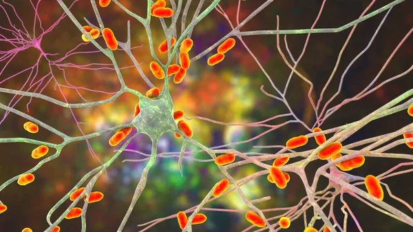 Bacteria infecting neurons, brain cells, 3D illustration. Conceptual illustration of bacterial encephalitis, meningitis, bacterial infection of brain tissue