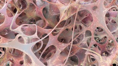 Osteoporotik trabeküler kemik, 3 boyutlu illüstrasyon kemiklerde giderek daha az ve ince trabeküle ve osteoporoz gösteriyor.