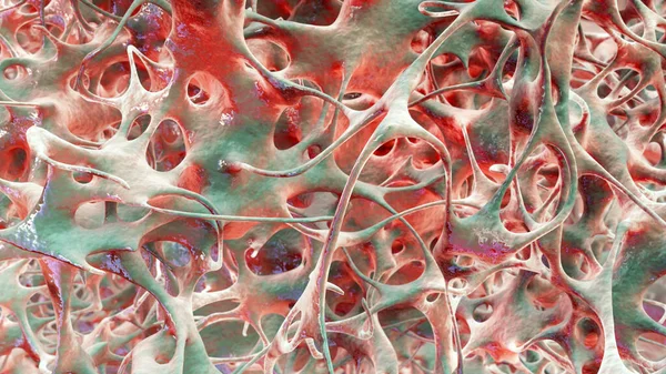 Osteoporotik trabeküler kemik, 3 boyutlu illüstrasyon kemiklerde giderek daha az ve ince trabeküle ve osteoporoz gösteriyor.