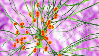 Streptococcus pneumoniae bakterisi nöronları ve beyin hücrelerini etkiliyor. Pnömokok ve diğer bakteriyel ensefalitin kavramsal 3 boyutlu çizimi, menenjit, beyin dokusunun bakteriyel enfeksiyonu