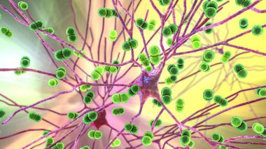 Streptococcus pneumoniae bakterisi nöronları ve beyin hücrelerini etkiliyor. Pnömokok ve diğer bakteriyel ensefalitin kavramsal 3 boyutlu çizimi, menenjit, beyin dokusunun bakteriyel enfeksiyonu