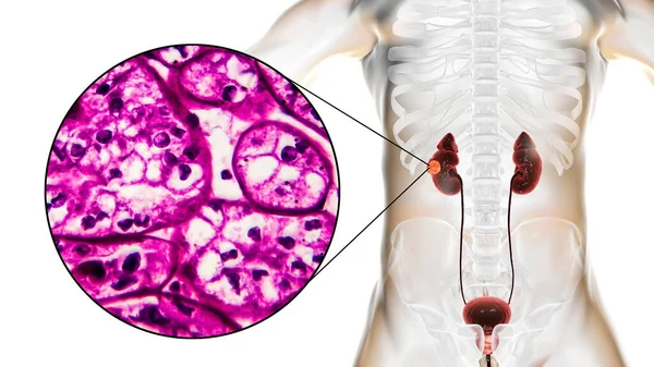 Cancro Rim Carcinoma Células Renais Ilustração Micrografia Luz — Fotografia de Stock
