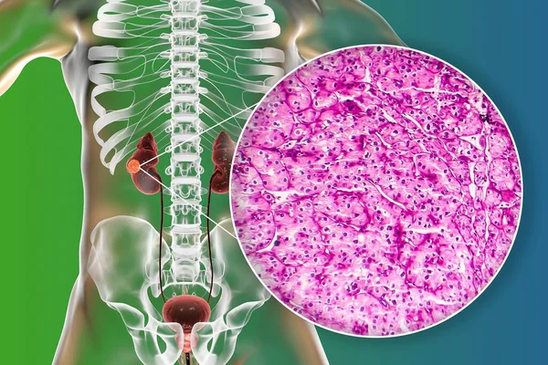 Cancro Rim Carcinoma Células Renais Ilustração Micrografia Luz — Fotografia de Stock