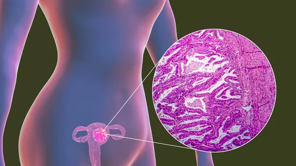 Câncer Uterino Ilustração Micrografia Luz Mostrando Tumor Maligno Útero Feminino — Fotografia de Stock