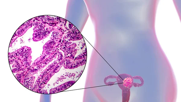 Câncer Uterino Ilustração Micrografia Luz Mostrando Tumor Maligno Útero Feminino — Fotografia de Stock