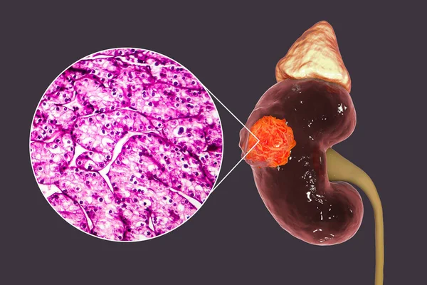 Njurcancer Njurcellscancer Illustration Och Ljusmikrograf — Stockfoto