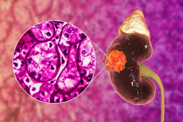 Nierkanker Niercelcarcinoom Illustratie Lichtmicrograaf — Stockfoto