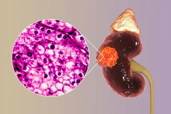 肾细胞癌 3D图解和光学显微图 — 图库照片