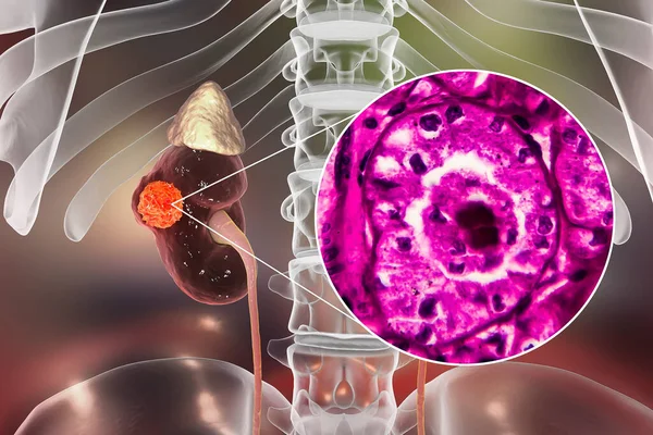 肾细胞癌 3D图解和光学显微图 — 图库照片