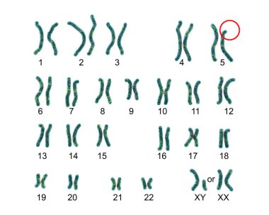 Karyotip Cri du chat, veya kedi çığlığı, sendrom, 3 boyutlu illüstrasyon etiketli. Kromozom 5 'teki kısmi kromozom silinmesinden kaynaklanan nadir görülen bir genetik bozukluk. Ayrıca 5-P ve Lejeune sendromu olarak da bilinir.