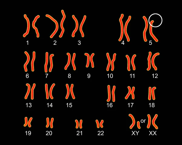 Karyotype of Cri du chat, or cat\'s cry, syndrome, labelled 3D illustration. A rare genetic disorder caused by a partial chromosome deletion on chromosome 5. Also known as 5p- and Lejeune\'s syndrome