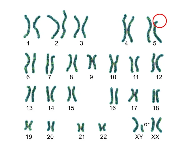 Cri Duチャット または猫の叫び 症候群 ラベル付き3DイラストのKaryotype 染色体上の一部の染色体欠失によるまれな遺伝性疾患5 およびLejune S症候群とも呼ばれる — ストック写真