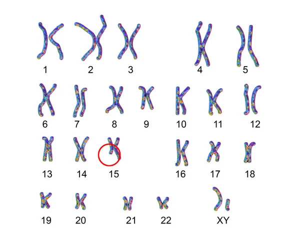 Karyotype Angelman Syndrome Labelled Illustration Trastorno Genético Causado Por Falta — Foto de Stock