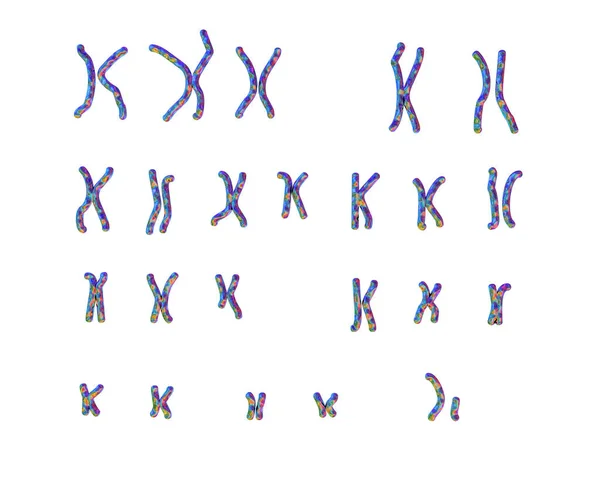 安吉尔曼综合征的核型 3D图解 15号染色体的一部分从母亲那里遗传下来的缺乏功能而引起的遗传性紊乱 — 图库照片