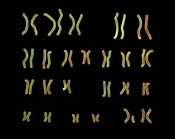 Karyotyp Angelmanova Syndromu Ilustrace Genetická Porucha Způsobená Nedostatečnou Funkcí Části — Stock fotografie