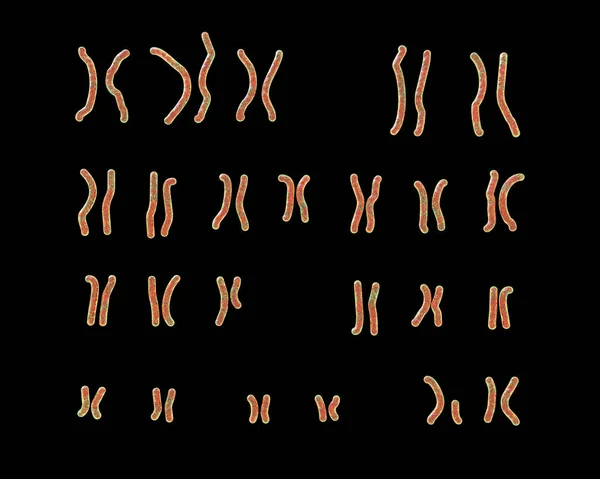 Karyotyp Prader Williho Syndromu Ilustrace Genetická Porucha Způsobená Nedostatečnou Funkcí — Stock fotografie