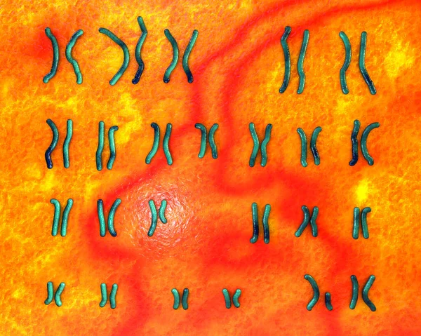 Karyotype Preder Wili症候群 3Dイラスト 父親から受け継いだ15番染色体の一部機能不全による遺伝性疾患 — ストック写真