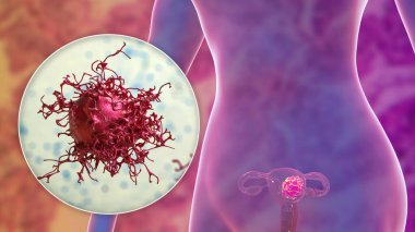 Rahim kanseri, 3 boyutlu illüstrasyon kadın rahminde habis tümör ve kanser hücresinin yakın plan görüntüsünü gösteriyor.