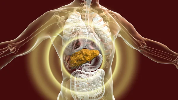 Liver with cirrhosis inside human body. 3D illustration