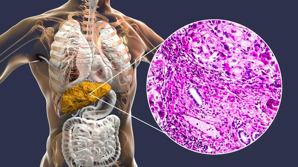 Hígado Con Cirrosis Dentro Del Cuerpo Humano Ilustración Micrografía Ligera — Foto de Stock