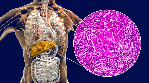 Liver Cirrhosis Human Body Illustration Light Micrograph Portal Cirrhosis — Stock Photo, Image