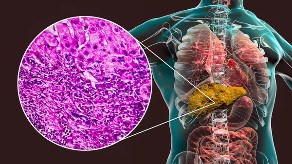 Fígado Com Cirrose Dentro Corpo Humano Ilustração Micrografia Luz Cirrose — Fotografia de Stock
