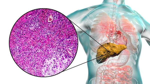Hígado Con Cirrosis Dentro Del Cuerpo Humano Ilustración Micrografía Ligera — Foto de Stock