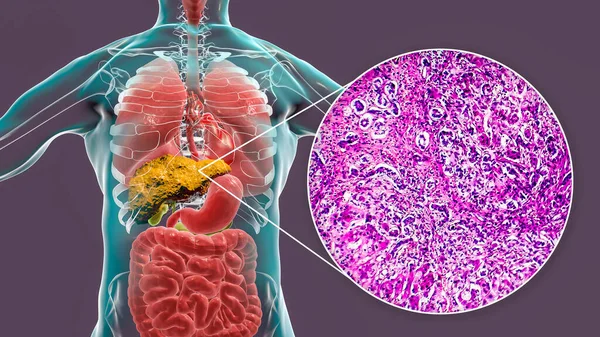 Hígado Con Cirrosis Dentro Del Cuerpo Humano Ilustración Micrografía Ligera —  Fotos de Stock