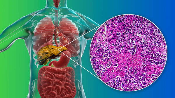 Liver with cirrhosis inside human body. 3D illustration and light micrograph of biliary cirrhosis