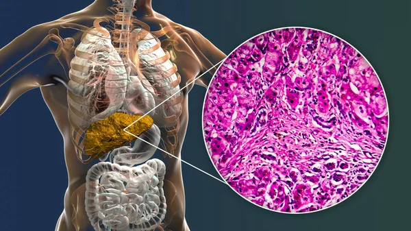 Liver Cirrhosis Human Body Illustration Light Micrograph Biliary Cirrhosis — Stock Photo, Image
