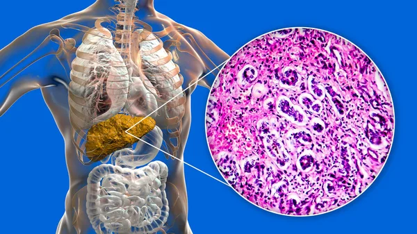 Hígado Con Cirrosis Dentro Del Cuerpo Humano Ilustración Micrografía Ligera — Foto de Stock