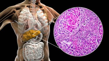 Liver with cirrhosis inside human body. 3D illustration and light micrograph of small nodular cirrhosis clipart