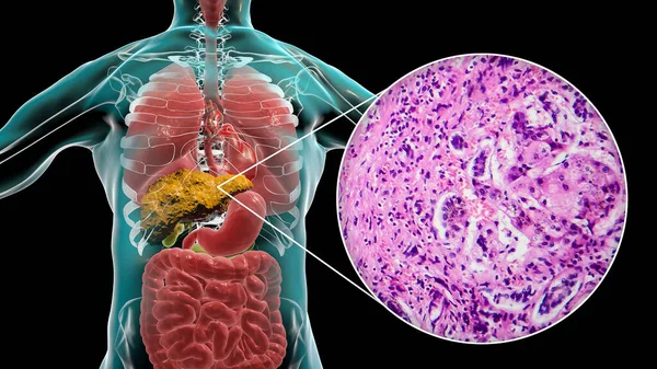 肝硬化与肝硬化在人体内 小结节性肝硬化的三维图及光学显微图 — 图库照片