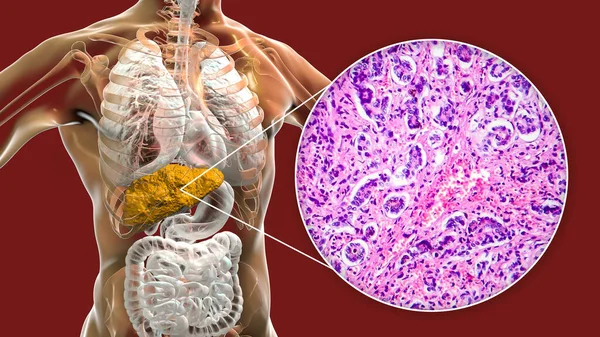 Fígado Com Cirrose Dentro Corpo Humano Ilustração Micrografia Luz Pequena — Fotografia de Stock
