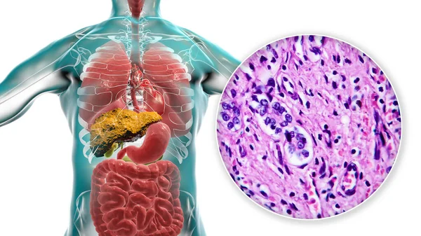 Liver with cirrhosis inside human body. 3D illustration and light micrograph of small nodular cirrhosis