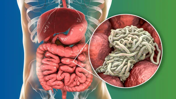 Parasitic worms in human intestine, 3D illustration. Ascaris lumbricoides and other round worms