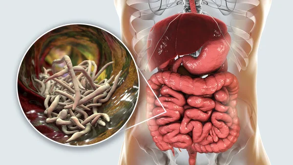 Parasitic worms in human intestine, 3D illustration. Ascaris lumbricoides and other round worms