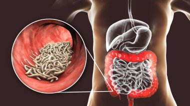 İnsana ait kalın bağırsaklarda parazit solucanlar, üç boyutlu çizimler. Enterobius vermicularis ve diğer yuvarlak solucanlar