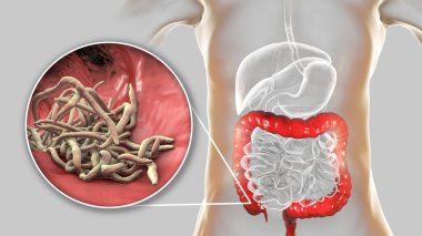 İnsana ait kalın bağırsaklarda parazit solucanlar, üç boyutlu çizimler. Enterobius vermicularis ve diğer yuvarlak solucanlar