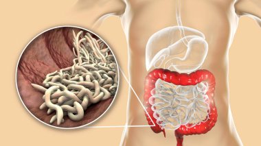 İnsana ait kalın bağırsaklarda parazit solucanlar, üç boyutlu çizimler. Enterobius vermicularis ve diğer yuvarlak solucanlar