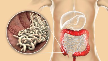 Parasitic worms in human large intestine, 3D illustration. Enterobius vermicularis and other round worms clipart