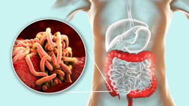 İnsana ait kalın bağırsaklarda parazit solucanlar, üç boyutlu çizimler. Enterobius vermicularis ve diğer yuvarlak solucanlar