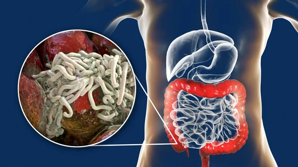Parasitic worms in human large intestine, 3D illustration. Enterobius vermicularis and other round worms