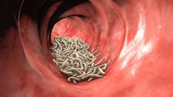 Parasitic worms in the lumen of intestine, 3D illustration. Ascaris lumbricoides, Enterobius vermicularis, and other round worms