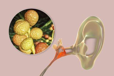 Mantar Candida 'nın sebep olduğu kronik eklem iltihabı, orta kulağın iltihaplı hastalığı, üç boyutlu illüstrasyon