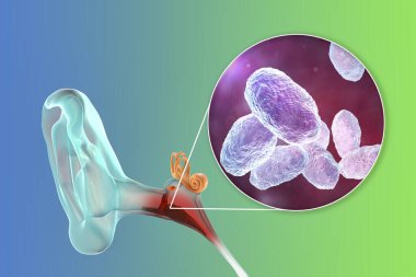 Haemophilus influenzae bakterisinden kaynaklanan kulak iltihabı medyası, orta kulağın iltihaplı hastalığı, üç boyutlu illüstrasyon