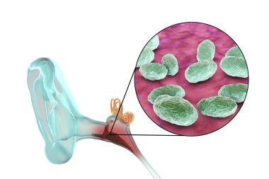 Haemophilus influenzae bakterisinden kaynaklanan kulak iltihabı medyası, orta kulağın iltihaplı hastalığı, üç boyutlu illüstrasyon