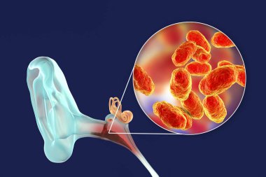 Haemophilus influenzae bakterisinden kaynaklanan kulak iltihabı medyası, orta kulağın iltihaplı hastalığı, üç boyutlu illüstrasyon