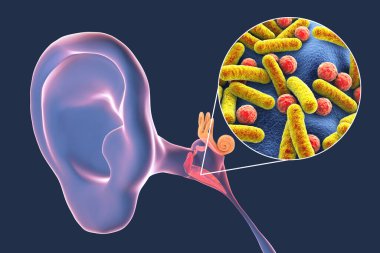 Otitis medyası, orta kulağın iltihaplı hastalığı, ve bakteriye yakından bakma, otitin nedensel faktörü, 3 boyutlu illüstrasyon