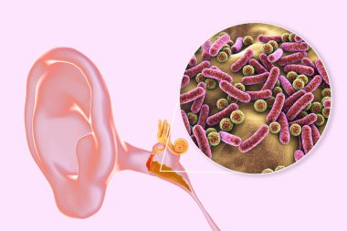 Otitis medyası, orta kulağın iltihaplı hastalığı, ve bakteriye yakından bakma, otitin nedensel faktörü, 3 boyutlu illüstrasyon